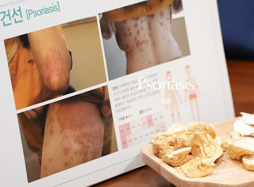 생기한의원 건선 페이지에서 확인하는 홍반과 인설 정보